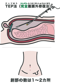 腹腔鏡手術（TEP）