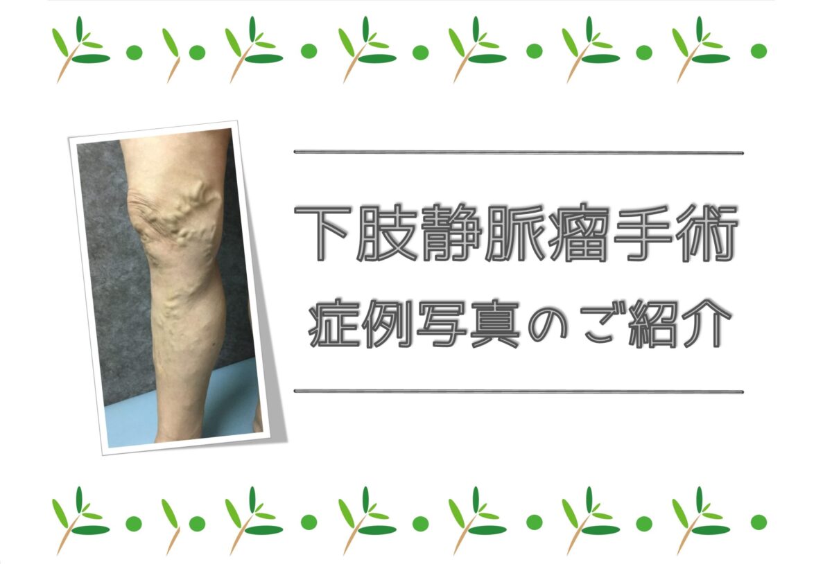下肢静脈瘤の術後症例写真(by大宮セントラルクリニック)